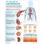 Anatomical Hypertension Understanding Chart 50 x 65cm