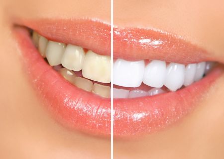 Picture for category Tooth Whitening